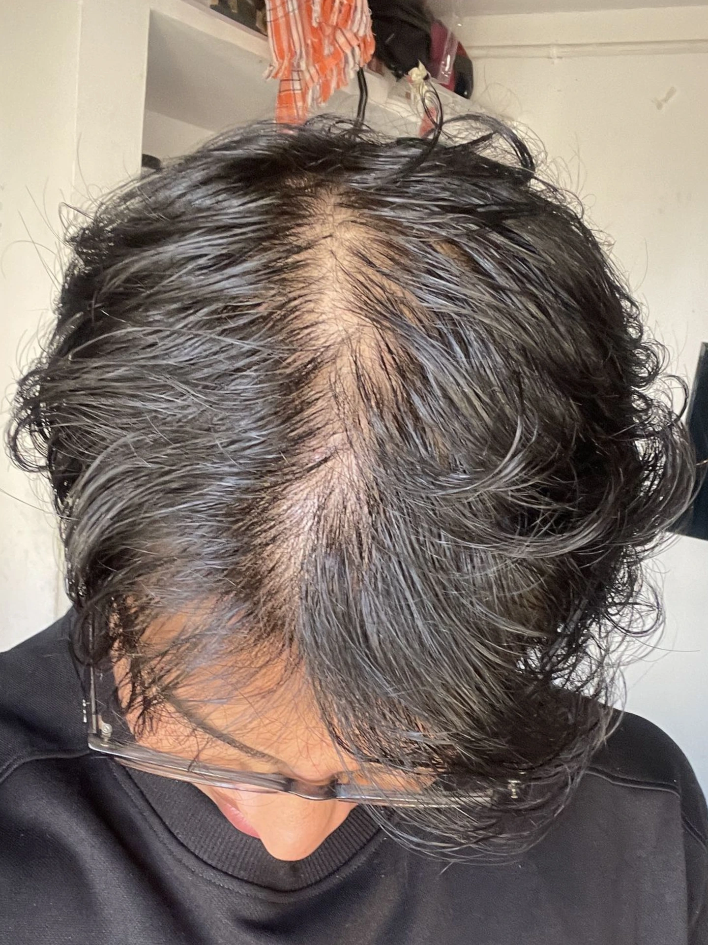Damaged scalp from androgenetic alopecia 